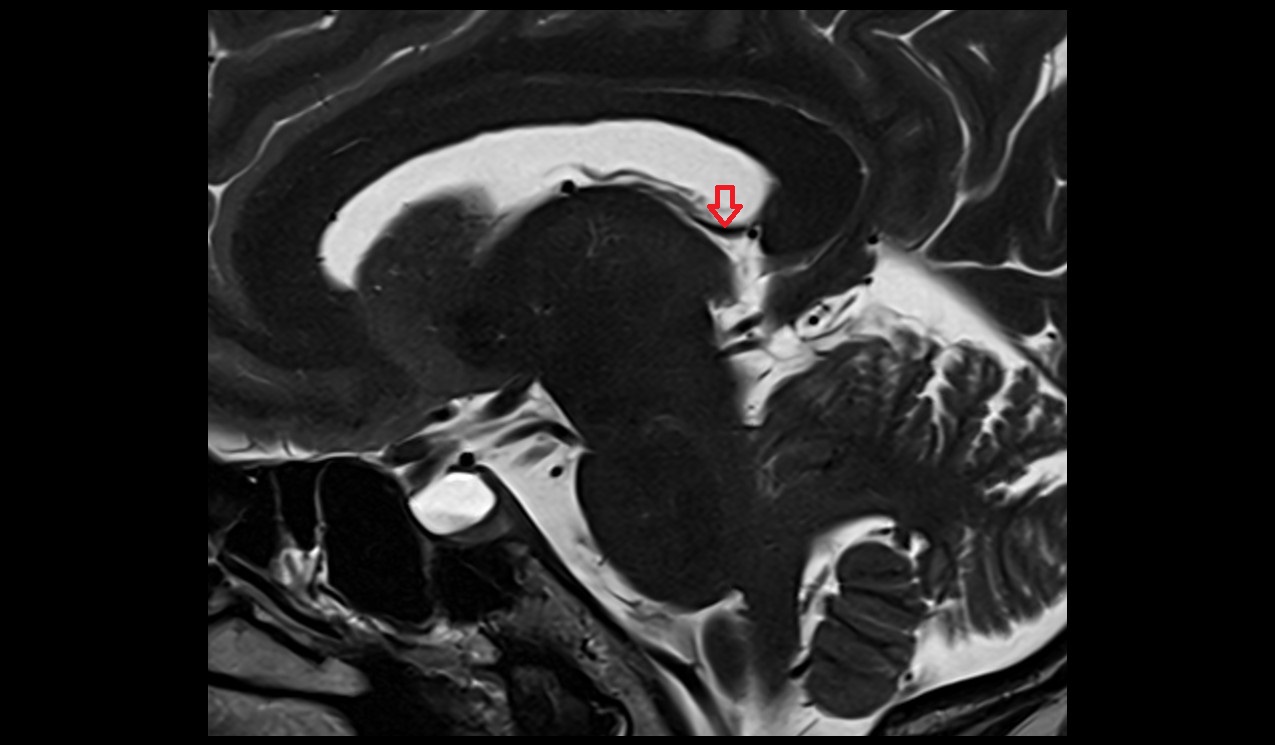 Crus of fornix mri 3t  sagittal image