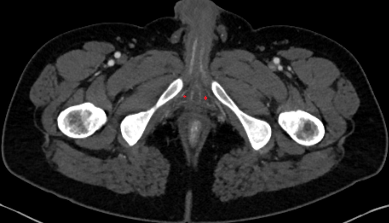 Crus of penis  ct axial  anatomy  image-img-00000-00000