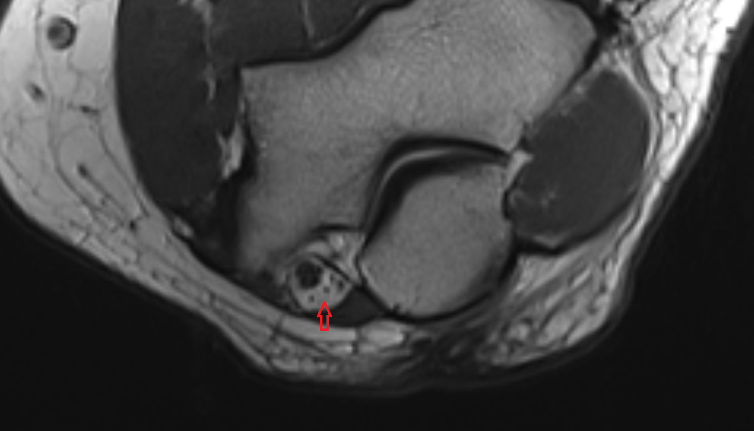Cubital tunnel of elbow  axial cross sectional anatomy 3T MRI AI enhanced radiology image -img-00000-00000