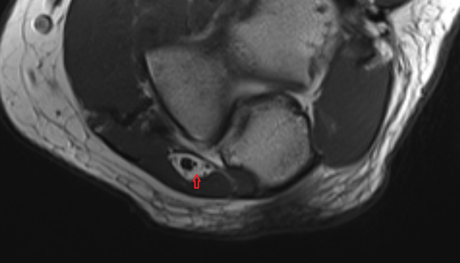 Cubital tunnel of elbow  axial cross sectional anatomy 3T MRI AI enhanced radiology image -img-00000-00000_00001