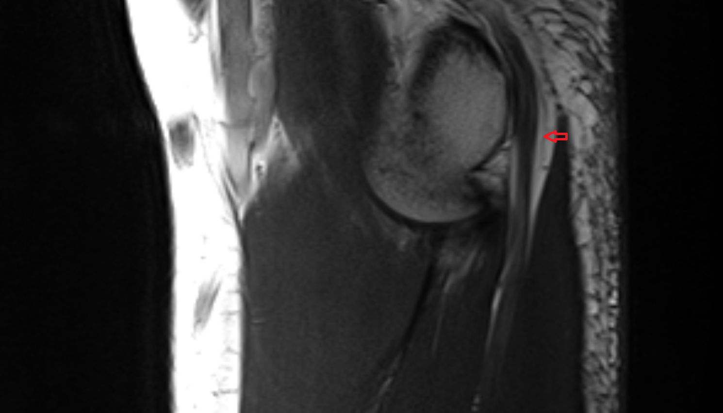 Cubital tunnel of elbow sag cross sectional anatomy 3T MRI AI enhanced radiology image -img-00000-00000