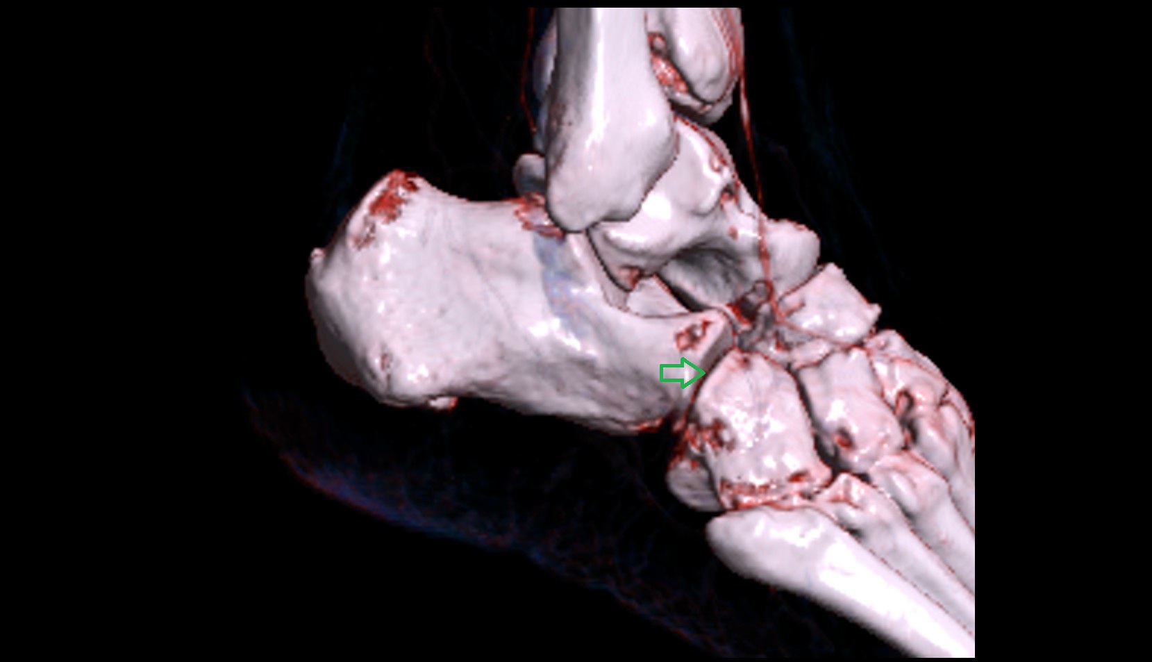 Cuboid articular surface