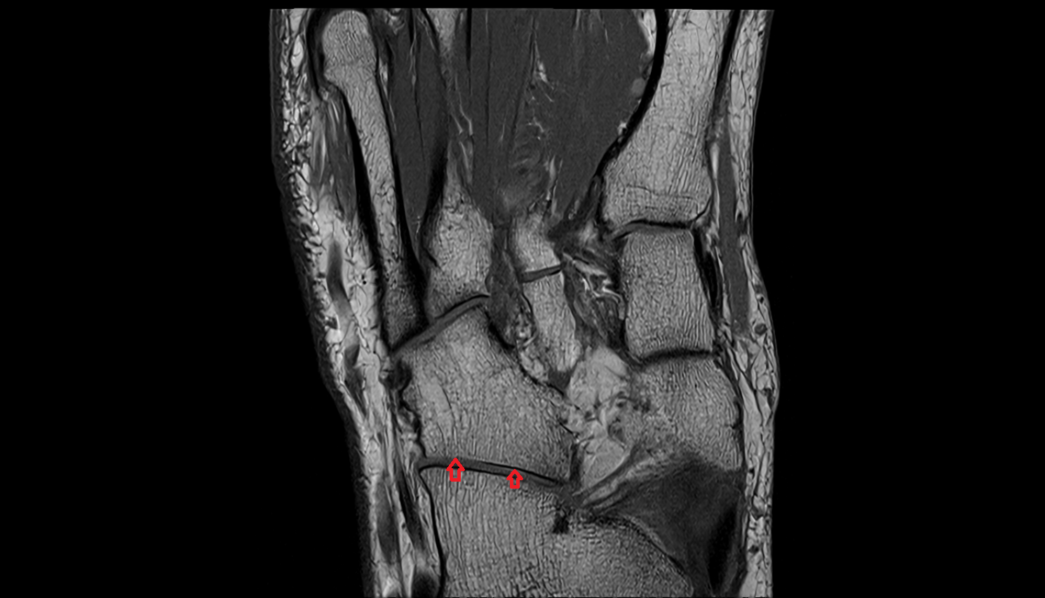 Cuboid articular surface mri  anatomy labelled image-img-00000-00000