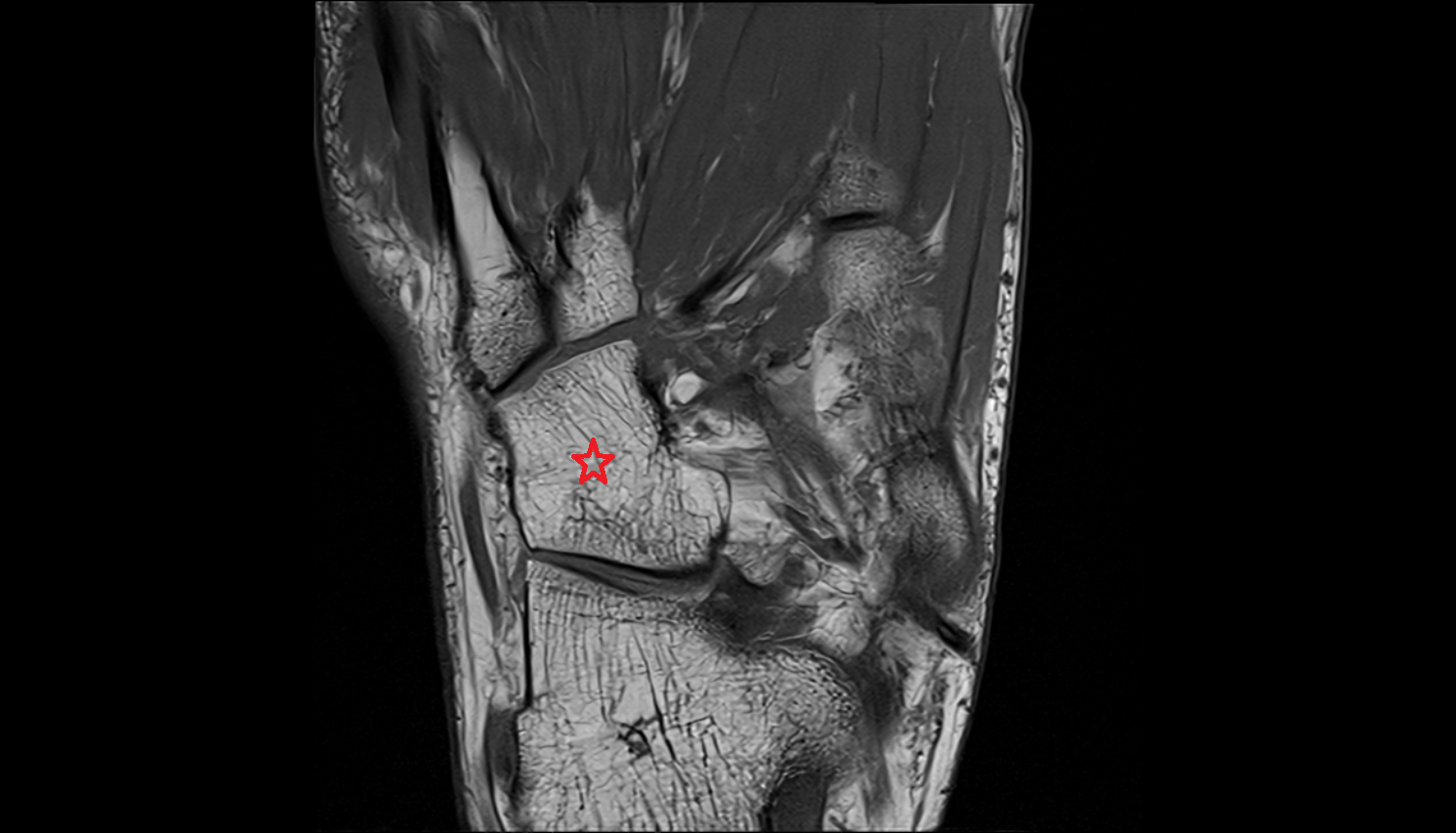 Cuboid bone MRI axial  cross sectional anatomy 3T MRI AI enhanced radiology image-img-00000-00000_00001
