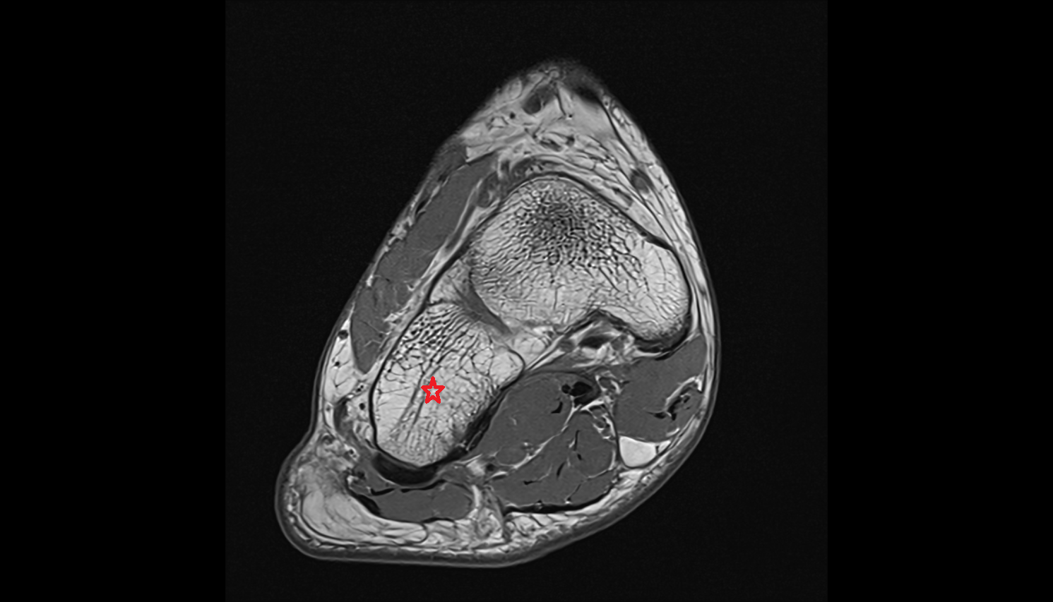 Cuboid bone MRI axial  cross sectional anatomy 3T MRI AI enhanced radiology image-img-00000-00000_00002