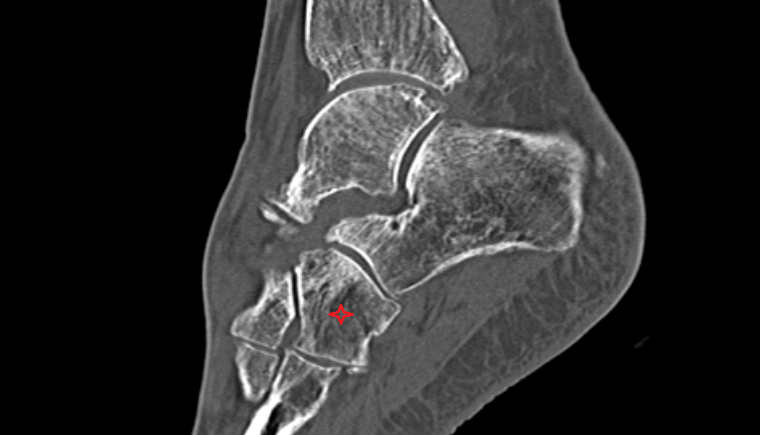 Cuboid bone sagittal  CT cross sectional anatomy radiology image-img-00000-00000