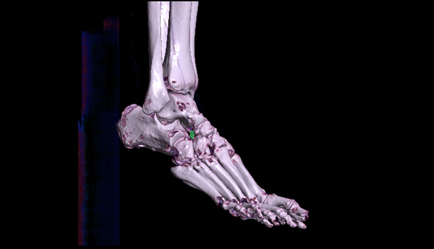 Cuboideonavicular joint 3d image