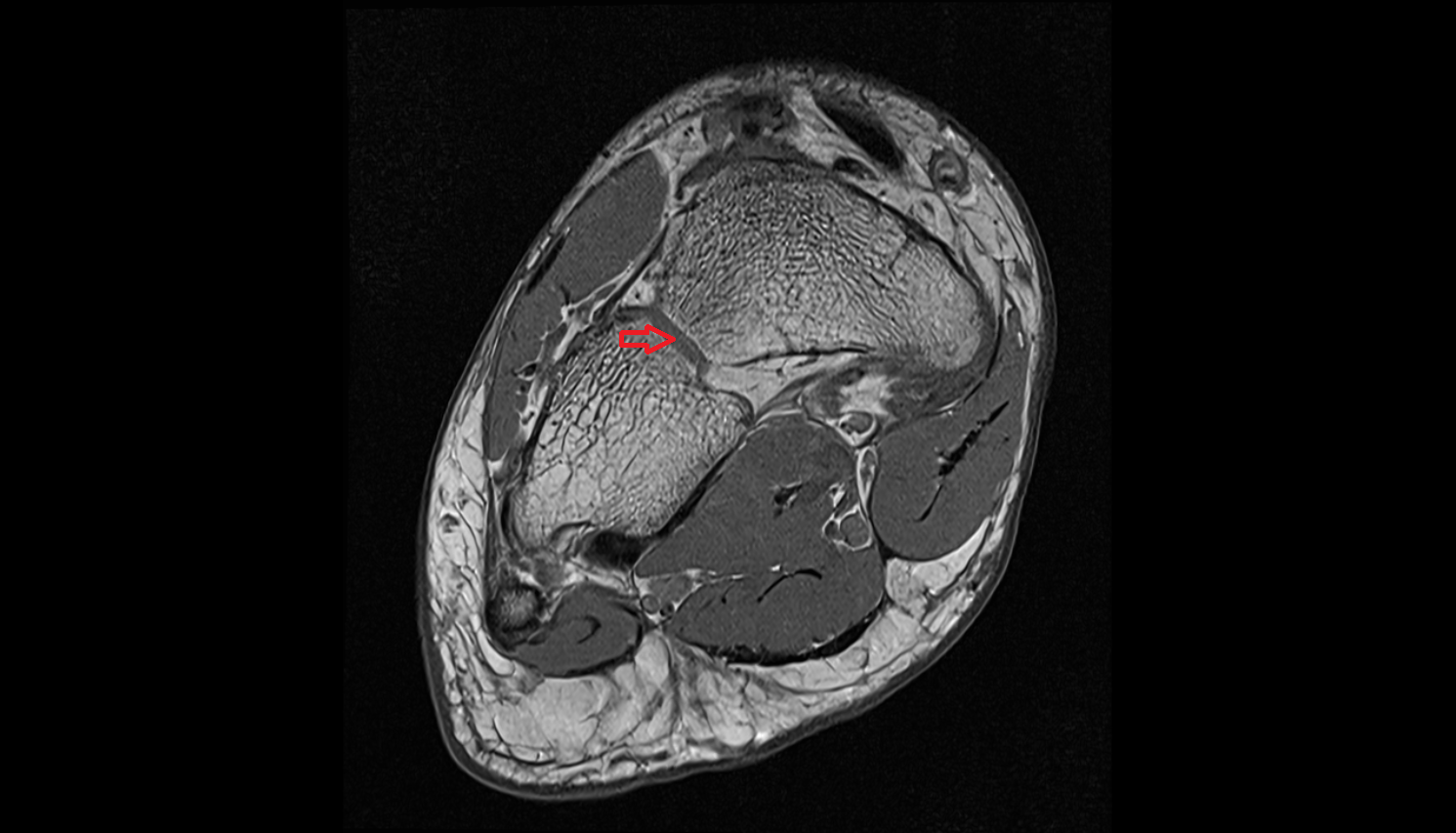 Cuboideonavicular joint axial cross sectional anatomy 3T MRI AI enhanced radiology image-img-00000-00000