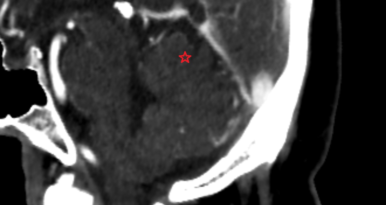 Culmen CT sagittal  anatomy image -img-00001-00001