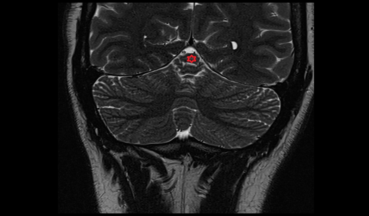 Culmen MRI 3T coronal image