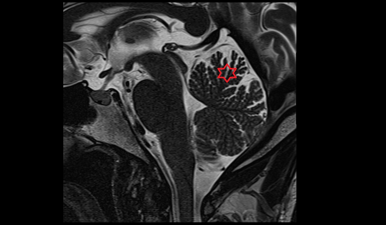 Culmen MRI 3T sagittal  image