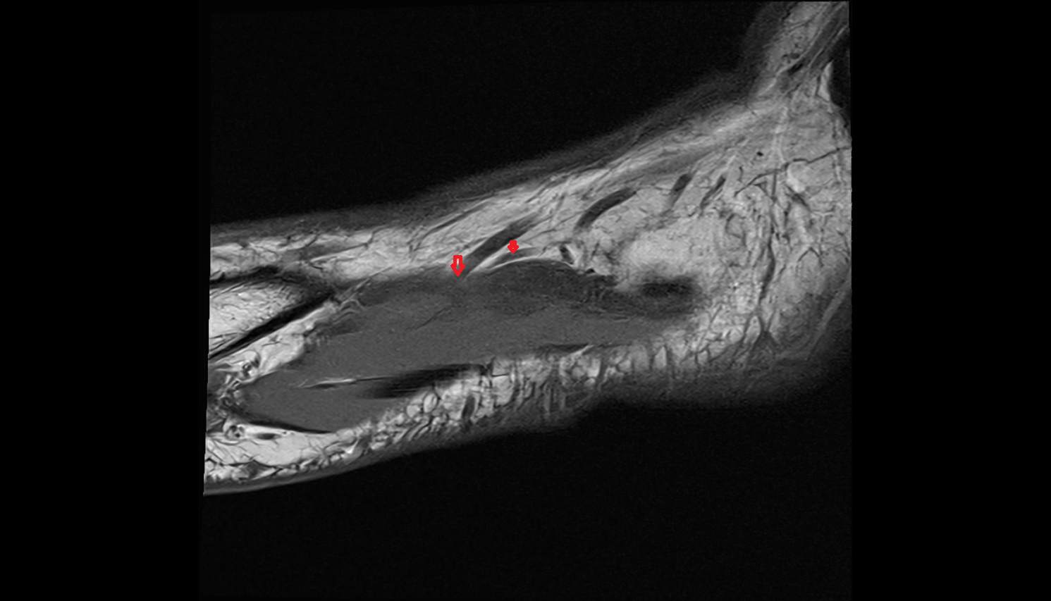 Cuneiform perforator veins  footaxial cross sectional anatomy 3T MRI AI enhanced radiology image-img-00000-00000_00001