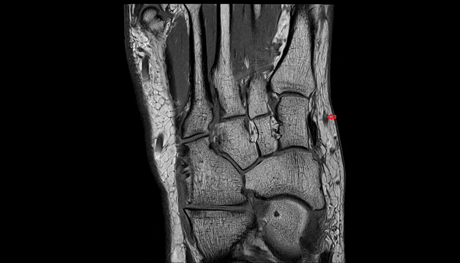 Cuneiform perforator veins  foot sagcross sectional anatomy 3T MRI AI enhanced radiology image-img-00000-00000