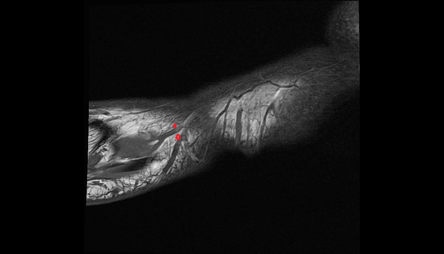 Cuneiform perforator veins  foot sag cross sectional anatomy 3T MRI AI enhanced radiology image-img-00000-00000_00002