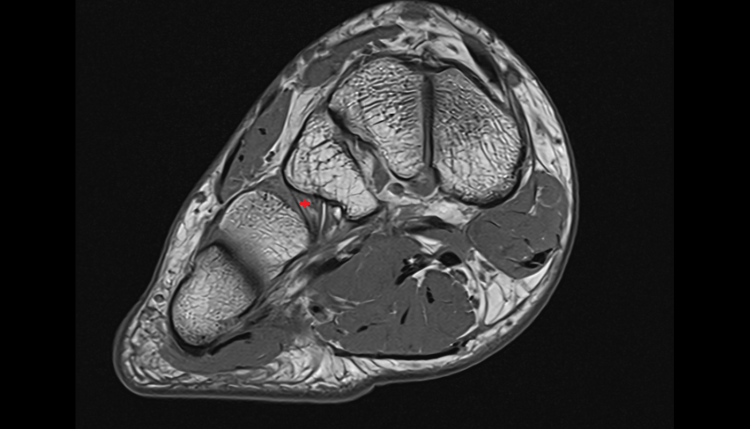 Cuneocuboid interosseous ligament axial  cross sectional anatomy 3T MRI AI enhanced radiology image-img-00000-00000