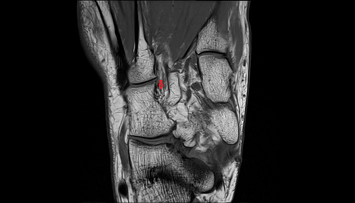 Cuneocuboid interosseous ligament coronal  cross sectional anatomy 3T MRI AI enhanced radiology image-img-00000-00000