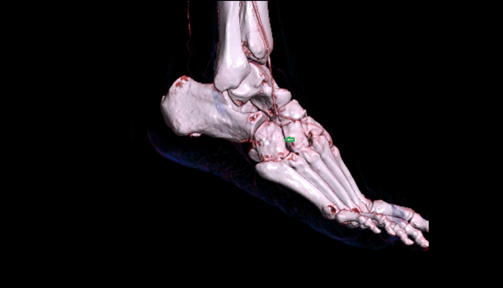 Cuneocuboid joint 3d image