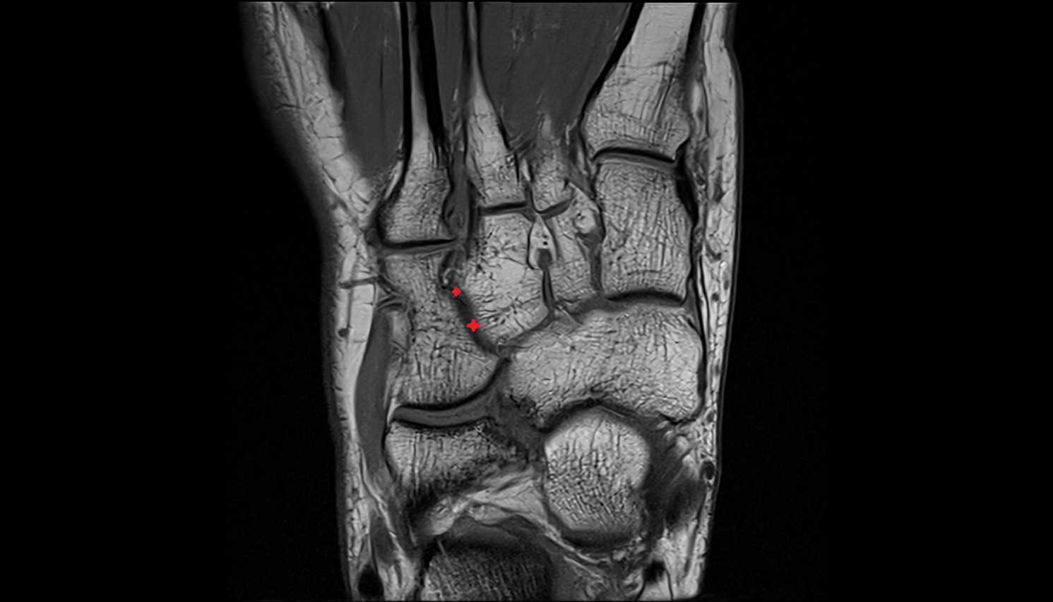 Cuneocuboid joint   MRI axial  cross sectional anatomy 3T MRI AI enhanced radiology image-img-00000-00000