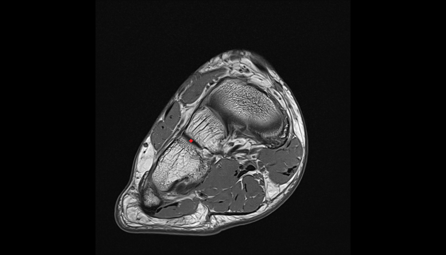 Cuneocuboid joint   MRI coronal  cross sectional anatomy 3T MRI AI enhanced radiology image-img-00000-00000