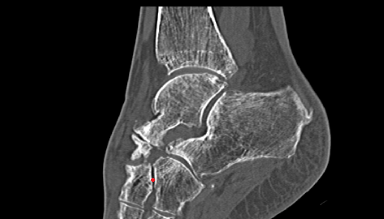 Cuneocuboid joint sagittal  CT cross sectional anatomy radiology image-img-00000-00000