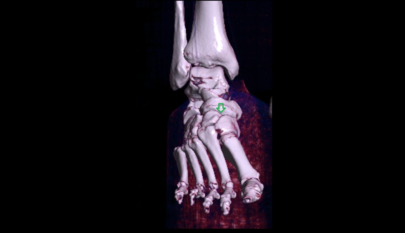 Cuneonavicular joint 3d