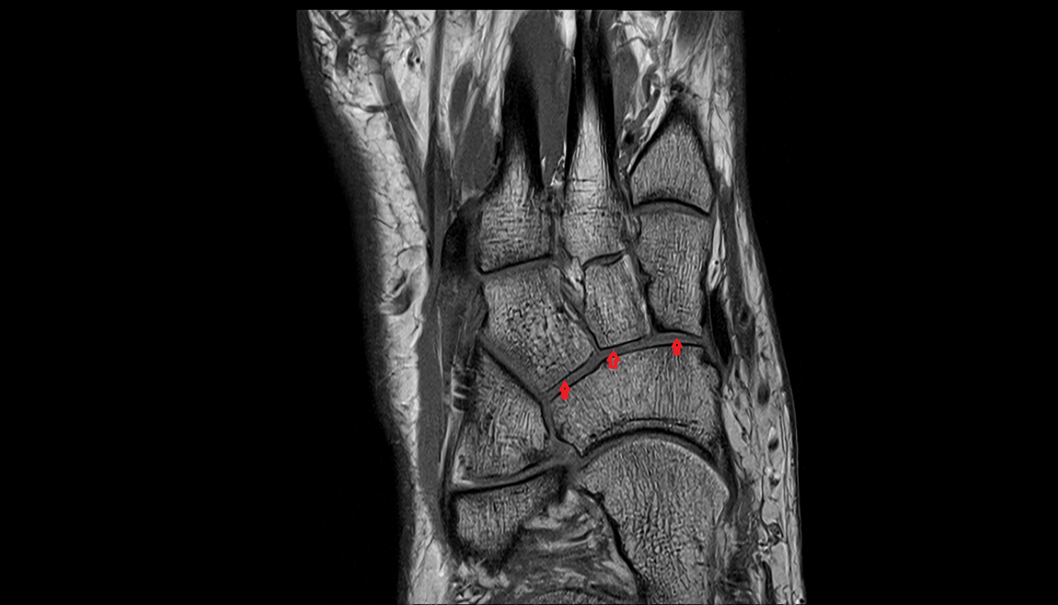 Cuneonavicular joint  coronal cross sectional anatomy 3T MRI AI enhanced radiology image-img-00000-00000