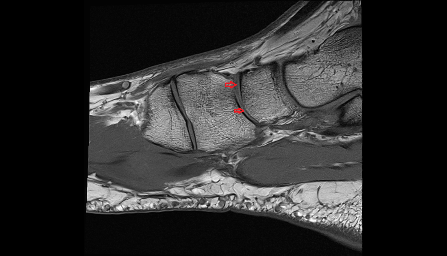 Cuneonavicular joint  sagittal cross sectional anatomy 3T MRI AI enhanced radiology image-img-00000-00000_00001