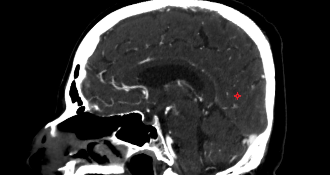 Cuneus  CT sagittal anatomy image -img-00001-00001
