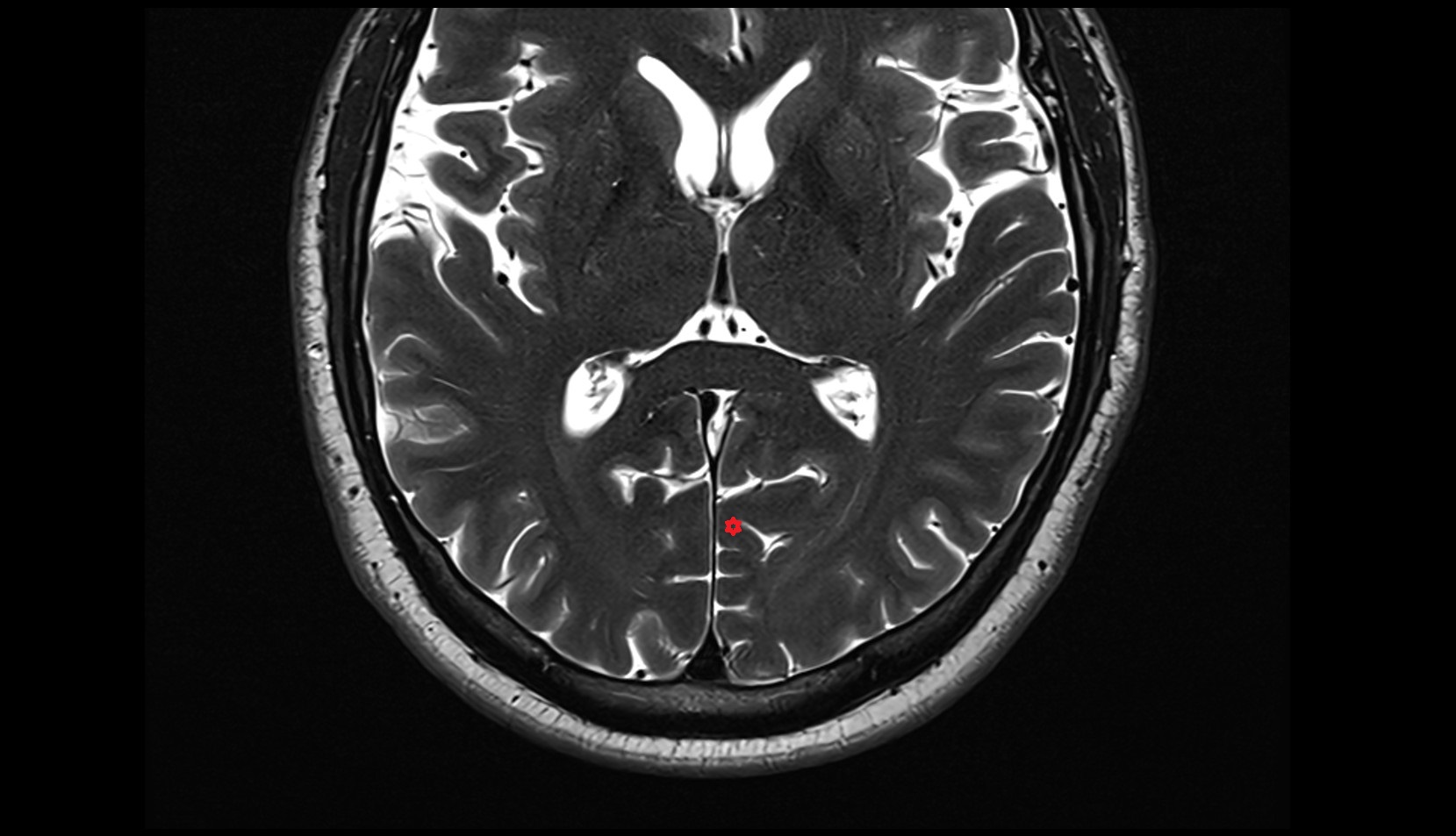 Cuneus mri 3t axial image