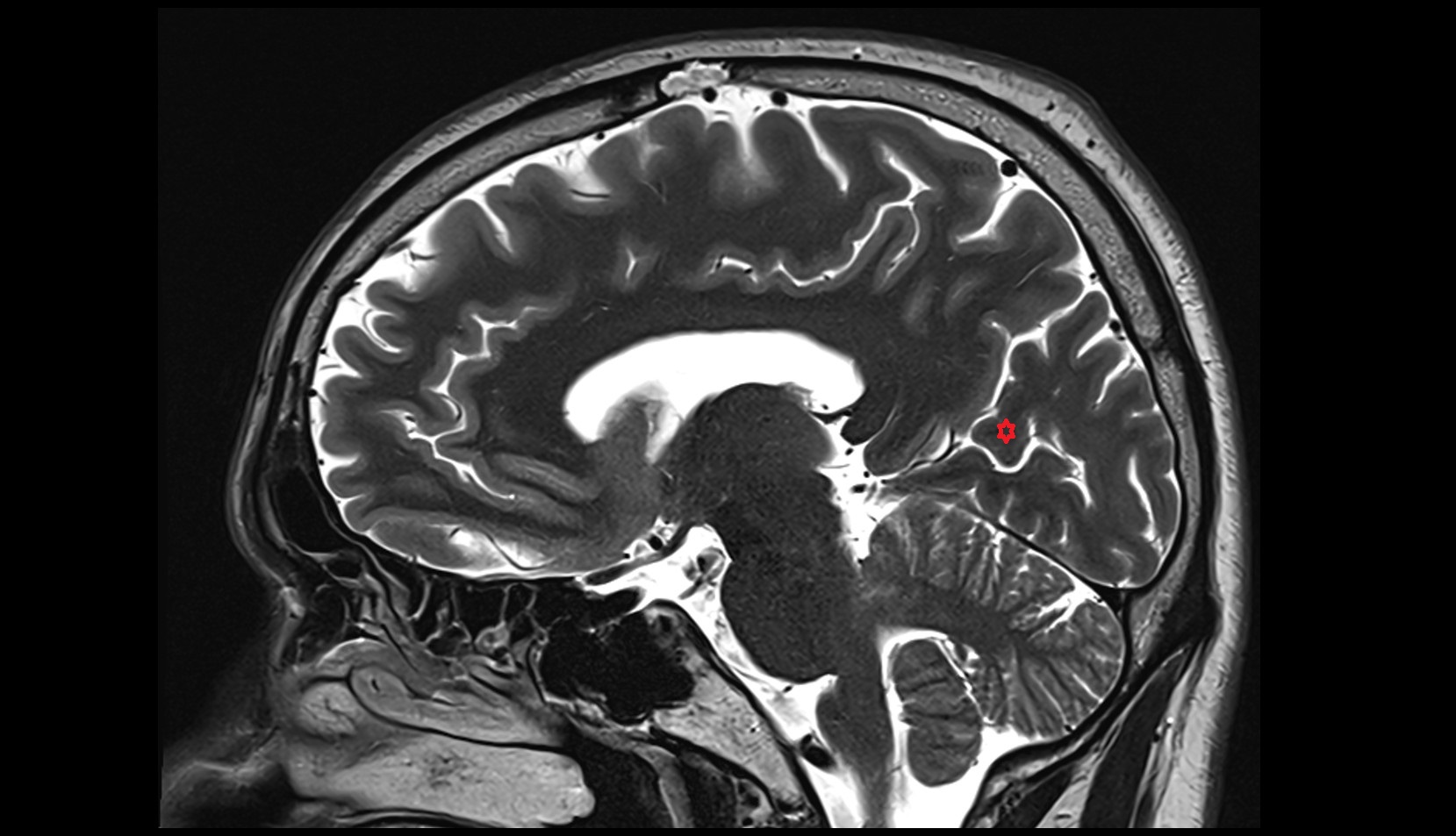 Cuneus mri 3t sagittal image