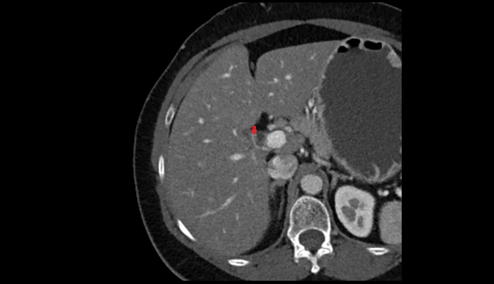 Cystic artery CT axial iamge