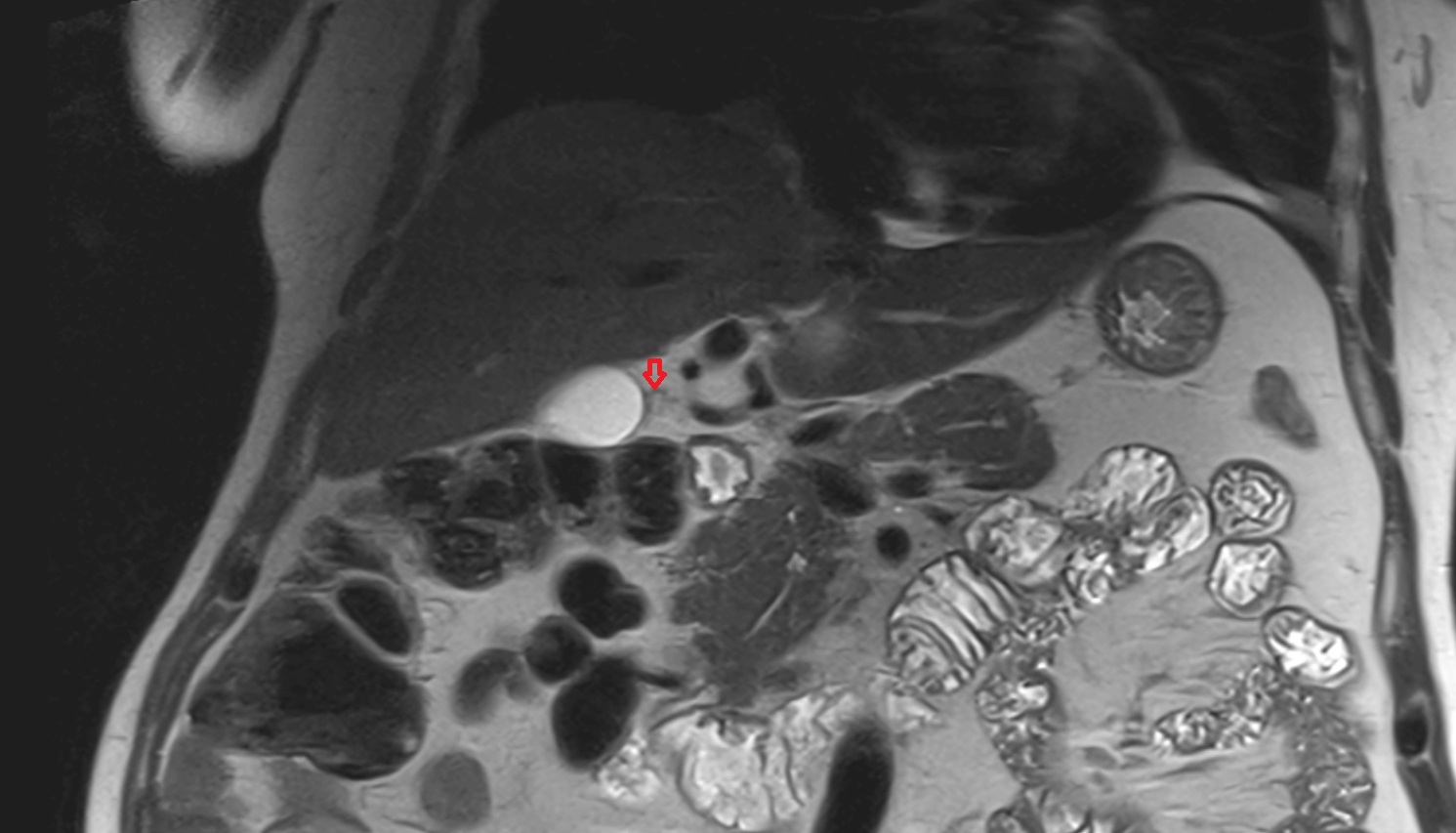 Cystic artery MRI CORONAL anatomy  image -img-00000-00000