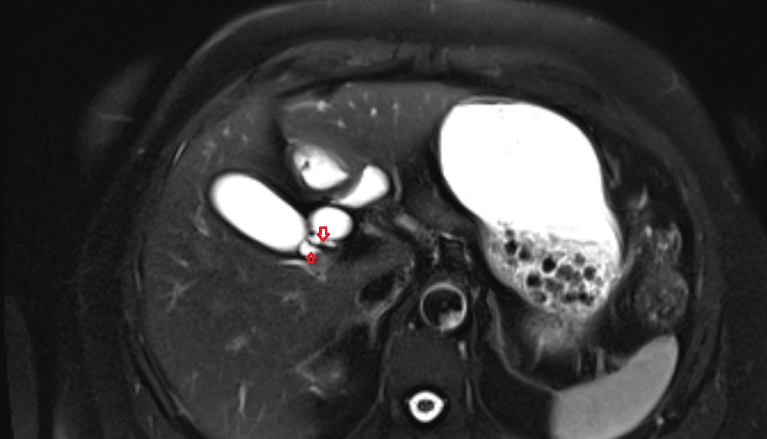 Cystic duct  mri axial  anatomy  image-img-00000-00000
