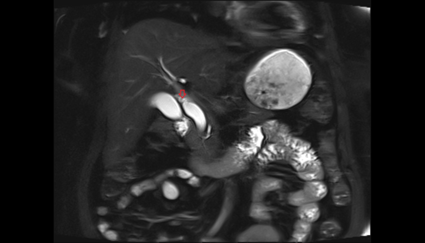Cystic duct  mri axial   cornal  image-img-00000-00000