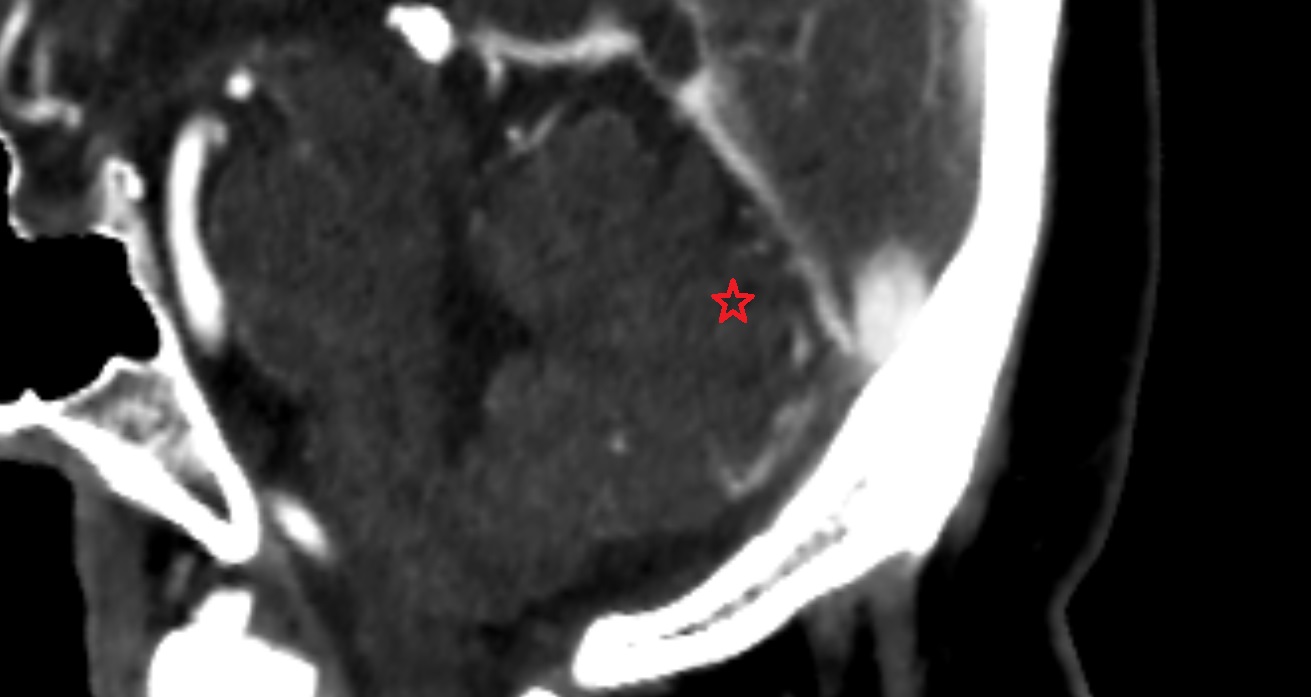 Declive CT sagittal  anatomy image -img-00001-00001