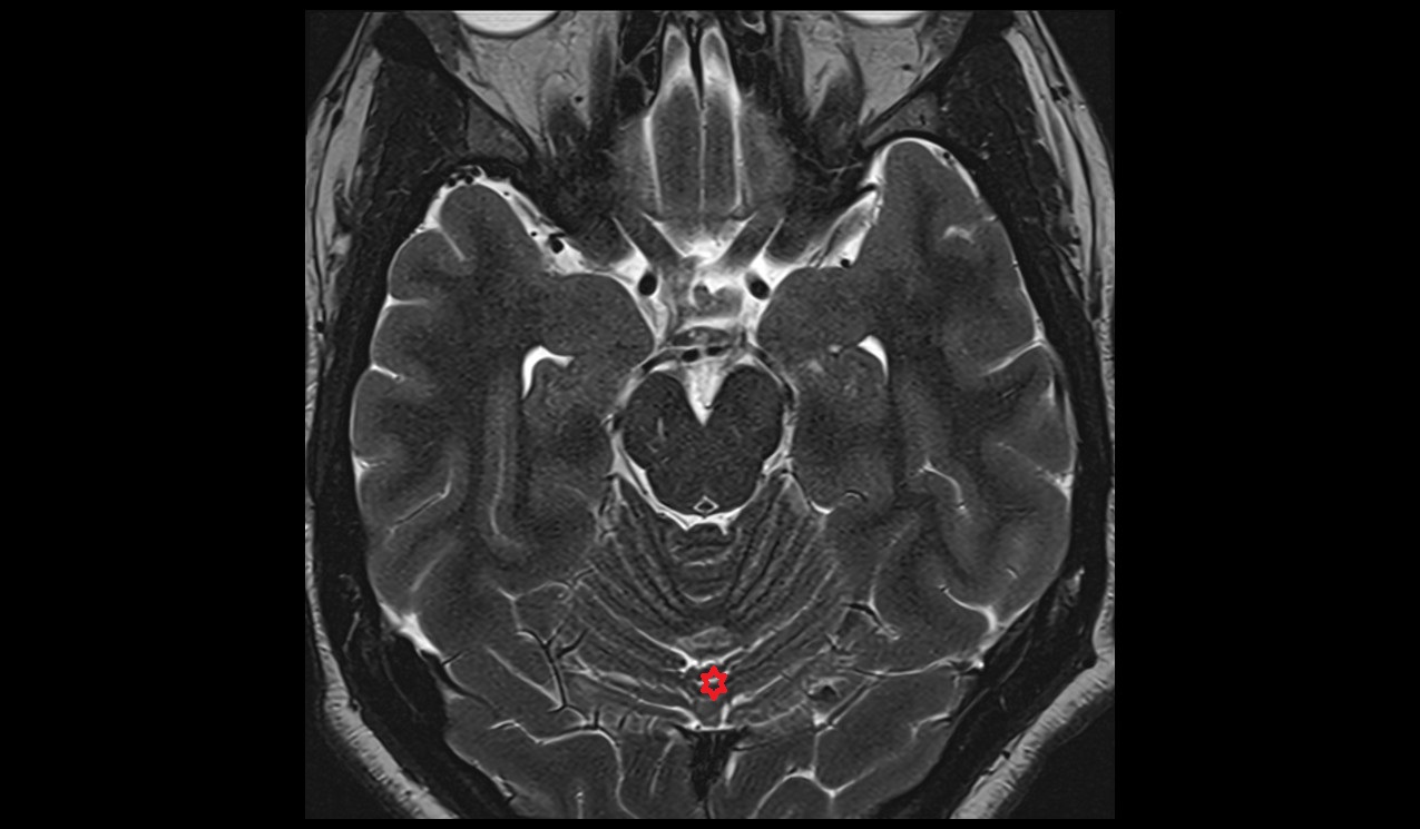 Declive MRI 3T axial  image