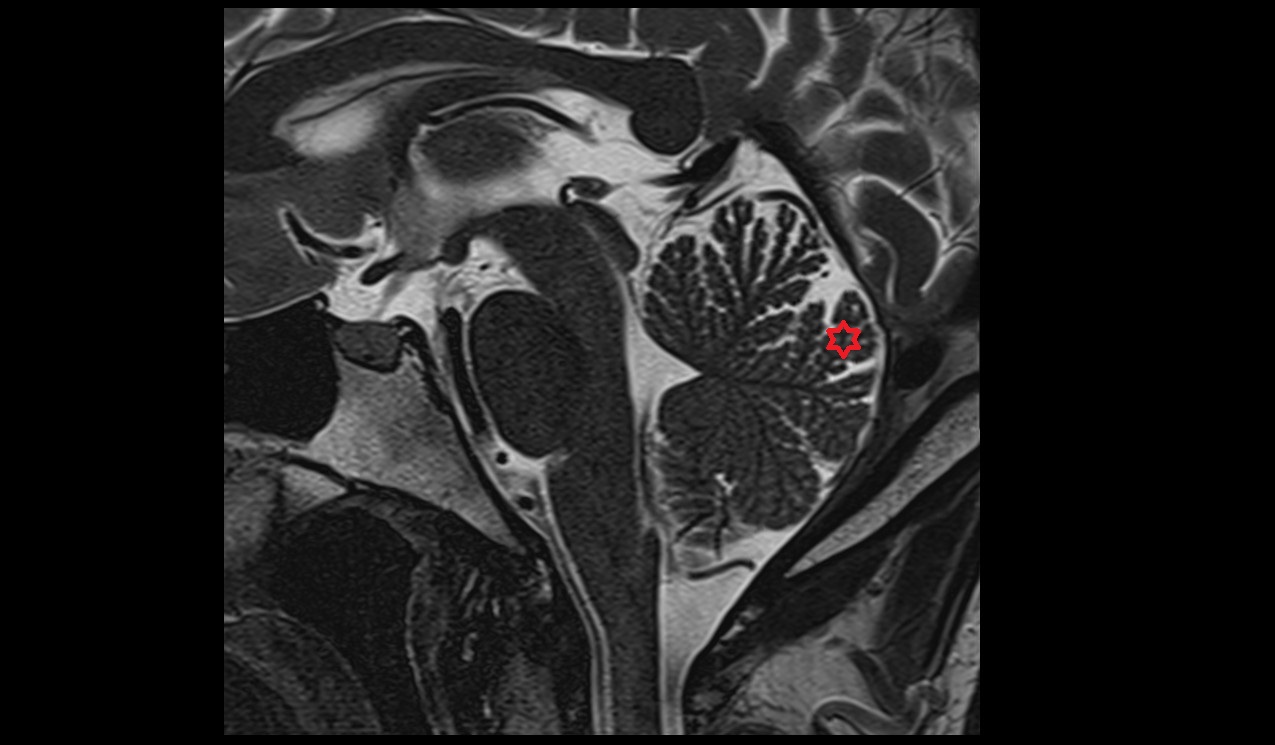 Declive MRI 3T sagital image