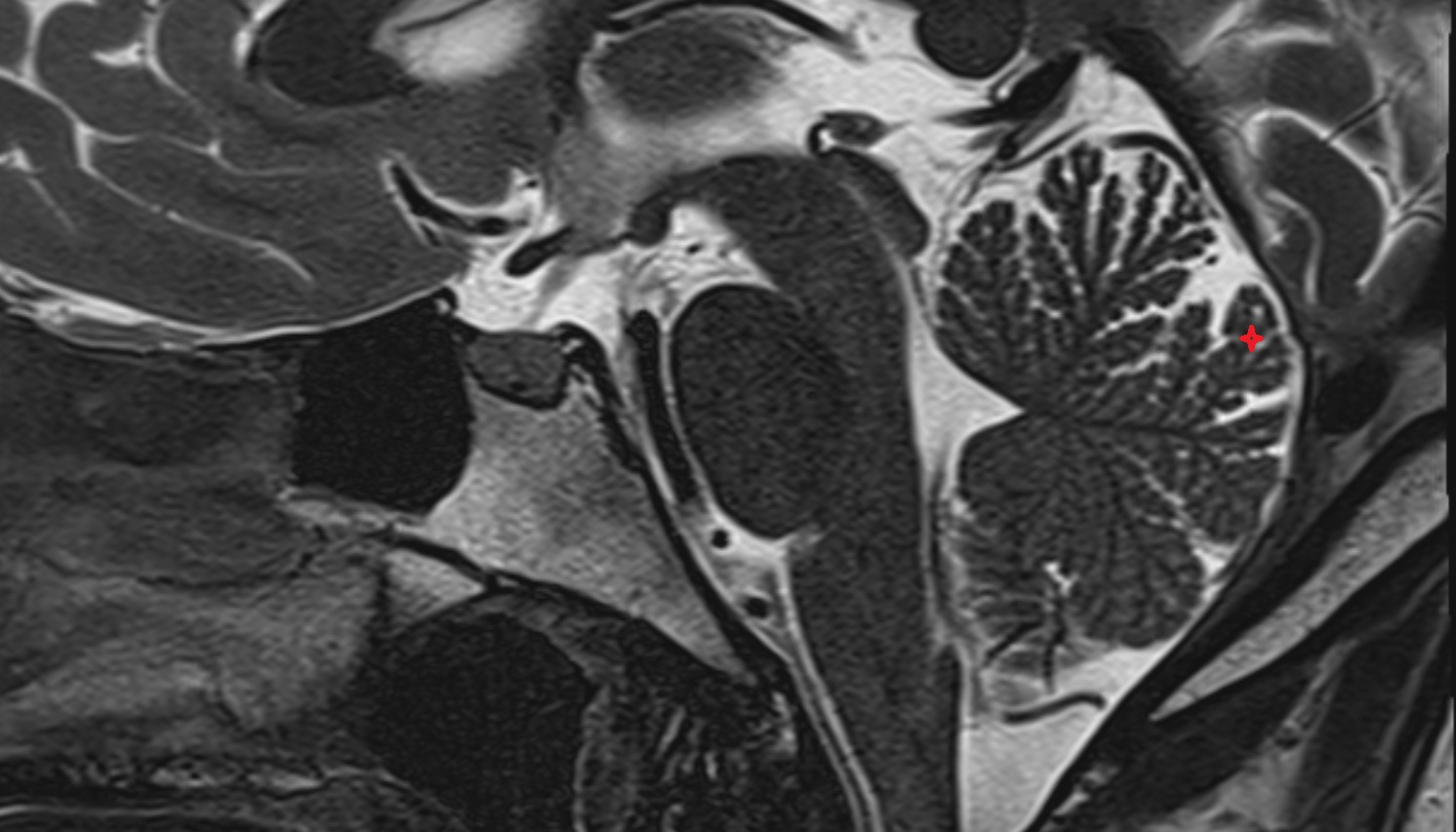 Declive (VI) of Cerebellum mri sag  image -img-00000-00000