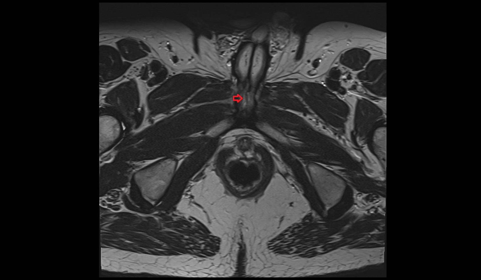 Deep Dorsal Vein of Penis