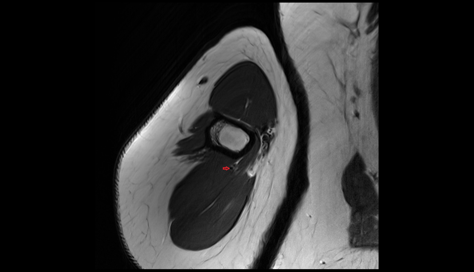 Deep brachial artery