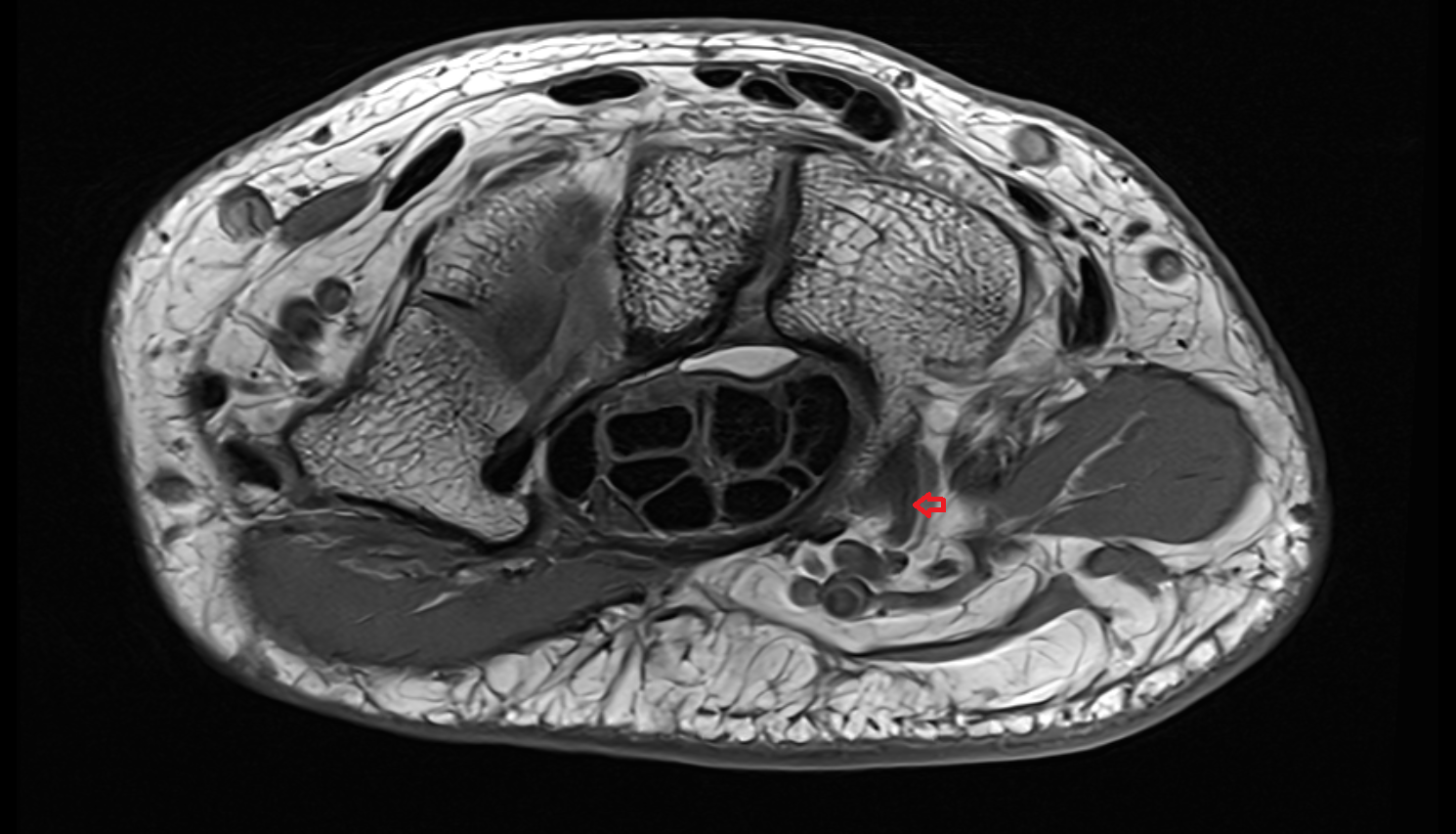 Deep branch of ulnar nerve axial cross sectional anatomy 3T MRI AI enhanced radiology image-img-00000-00000_00001