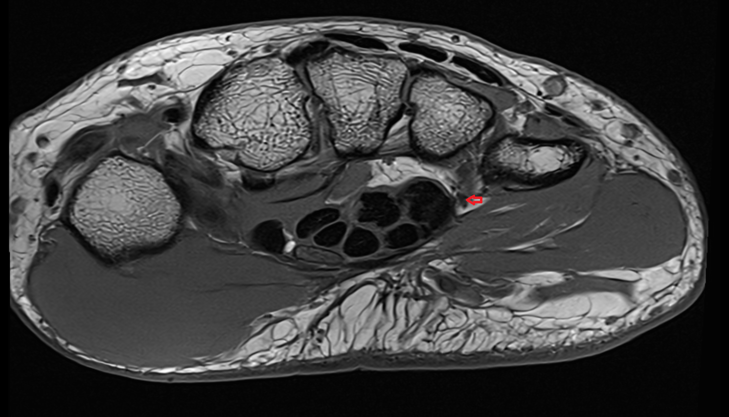 Deep branch of ulnar nerve axial cross sectional anatomy 3T MRI AI enhanced radiology image-img-00000-00000_00002