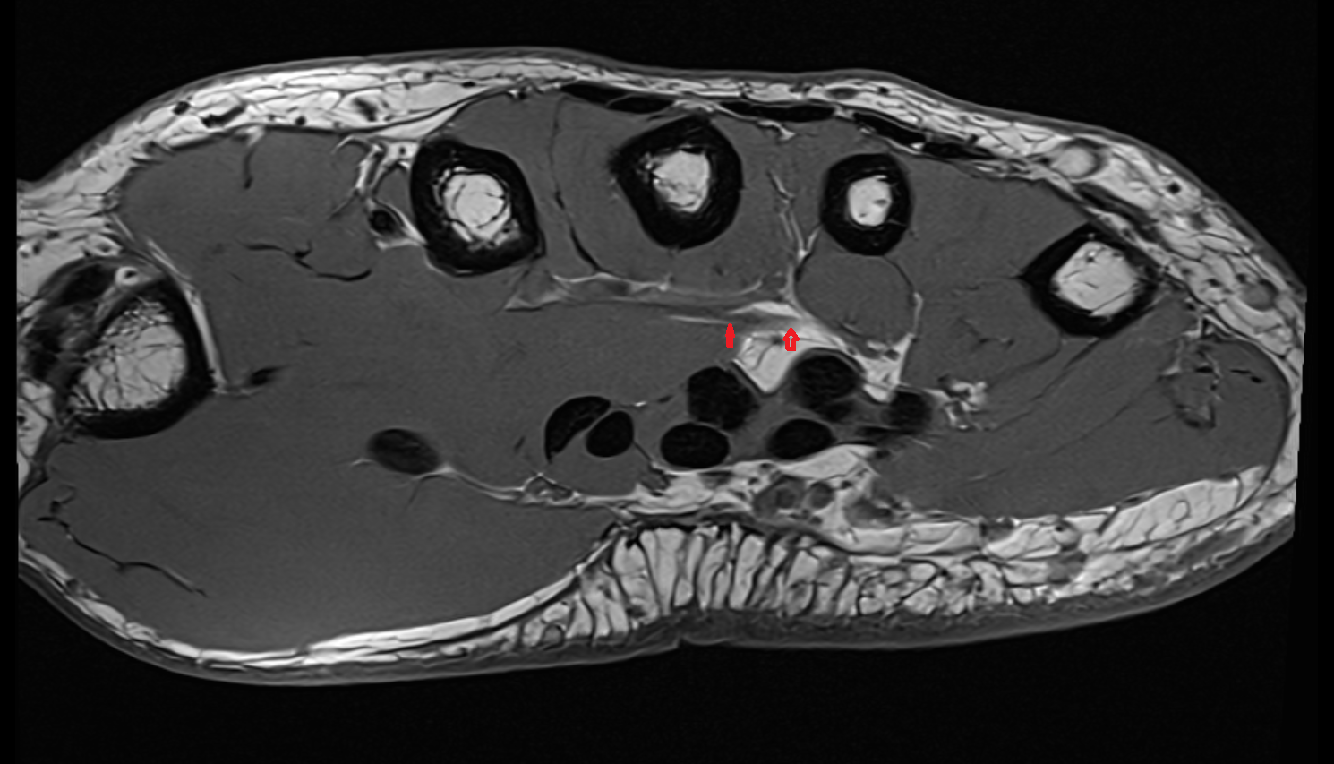 Deep branch of ulnar nerve axial cross sectional anatomy 3T MRI AI enhanced radiology image-img-00000-00000_00004