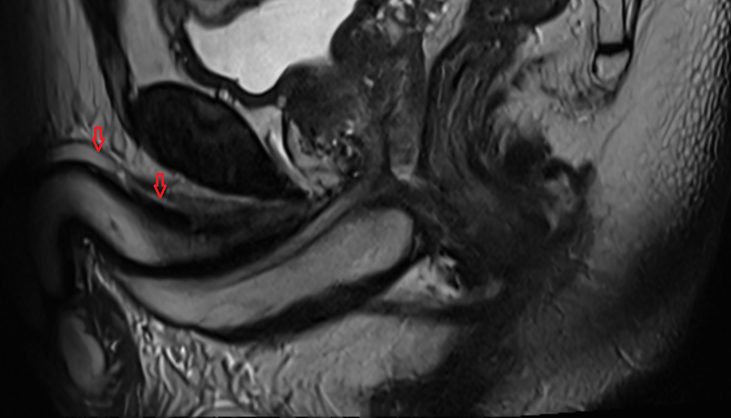 Deep dorsal vein of penis  MRI axial  image-img-00000-00000