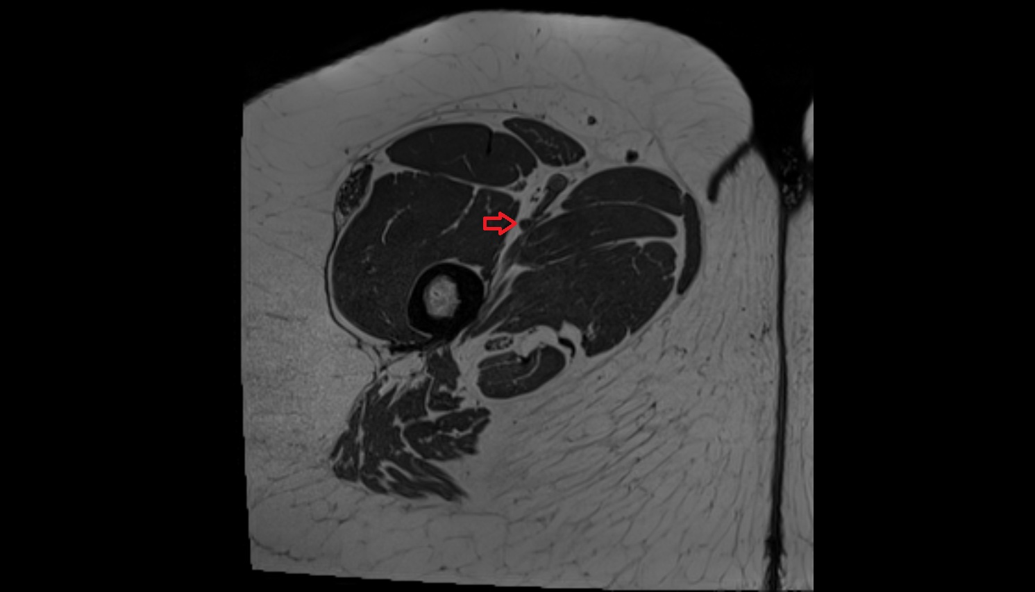 Deep femoral artery  MRI axial image  MRI  axial  anatomy  image-img-00000-00000