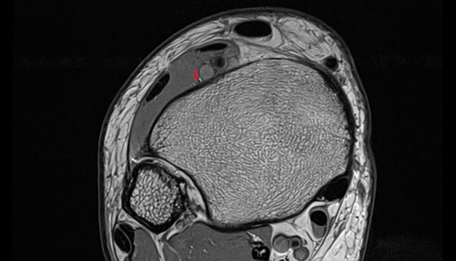 Deep fibular (peroneal) nerve axial  cross sectional anatomy 3T MRI AI enhanced radiology image-img-00000-00000