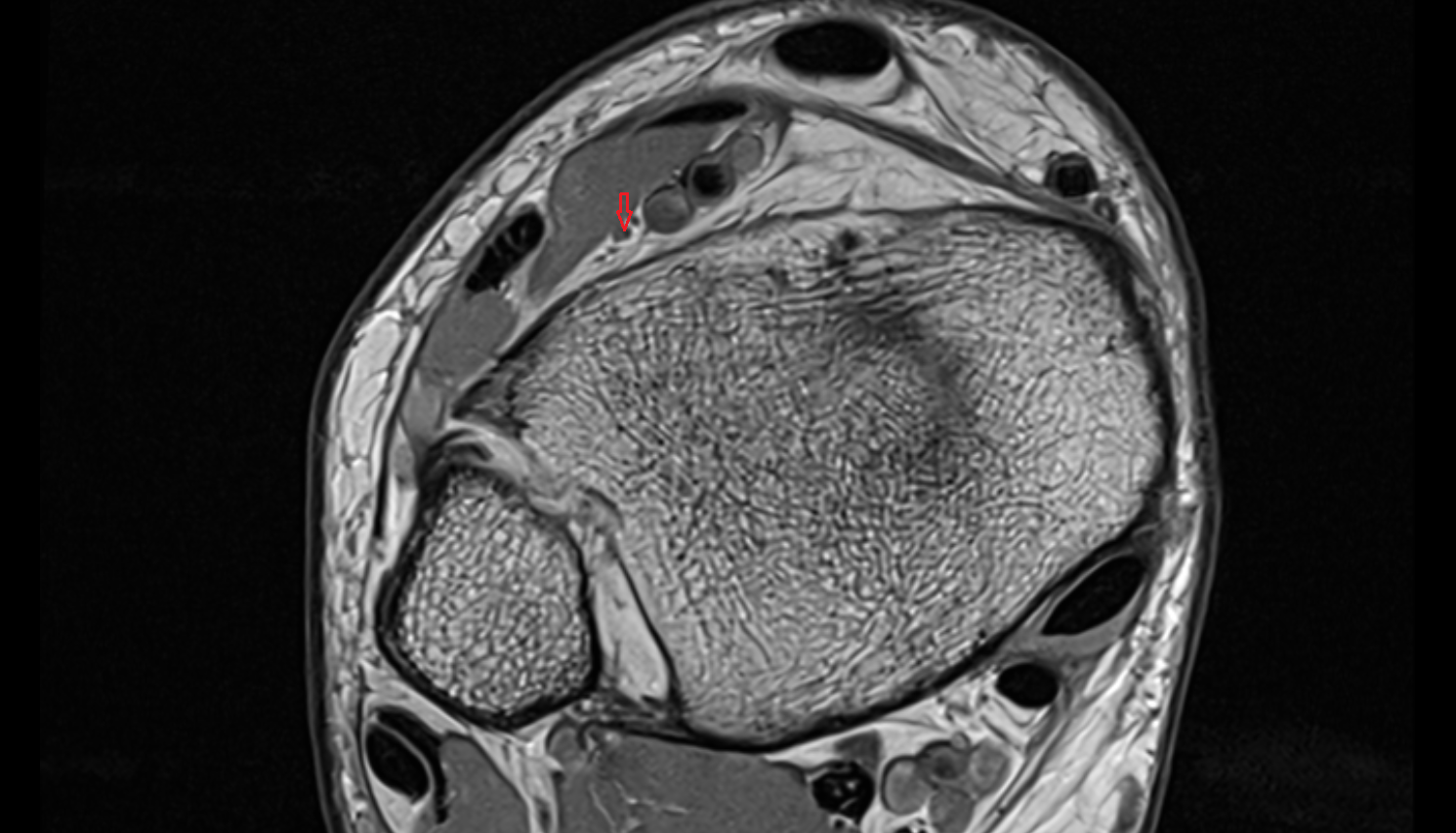 Deep fibular (peroneal) nerve axial  cross sectional anatomy 3T MRI AI enhanced radiology image-img-00000-00000_00001