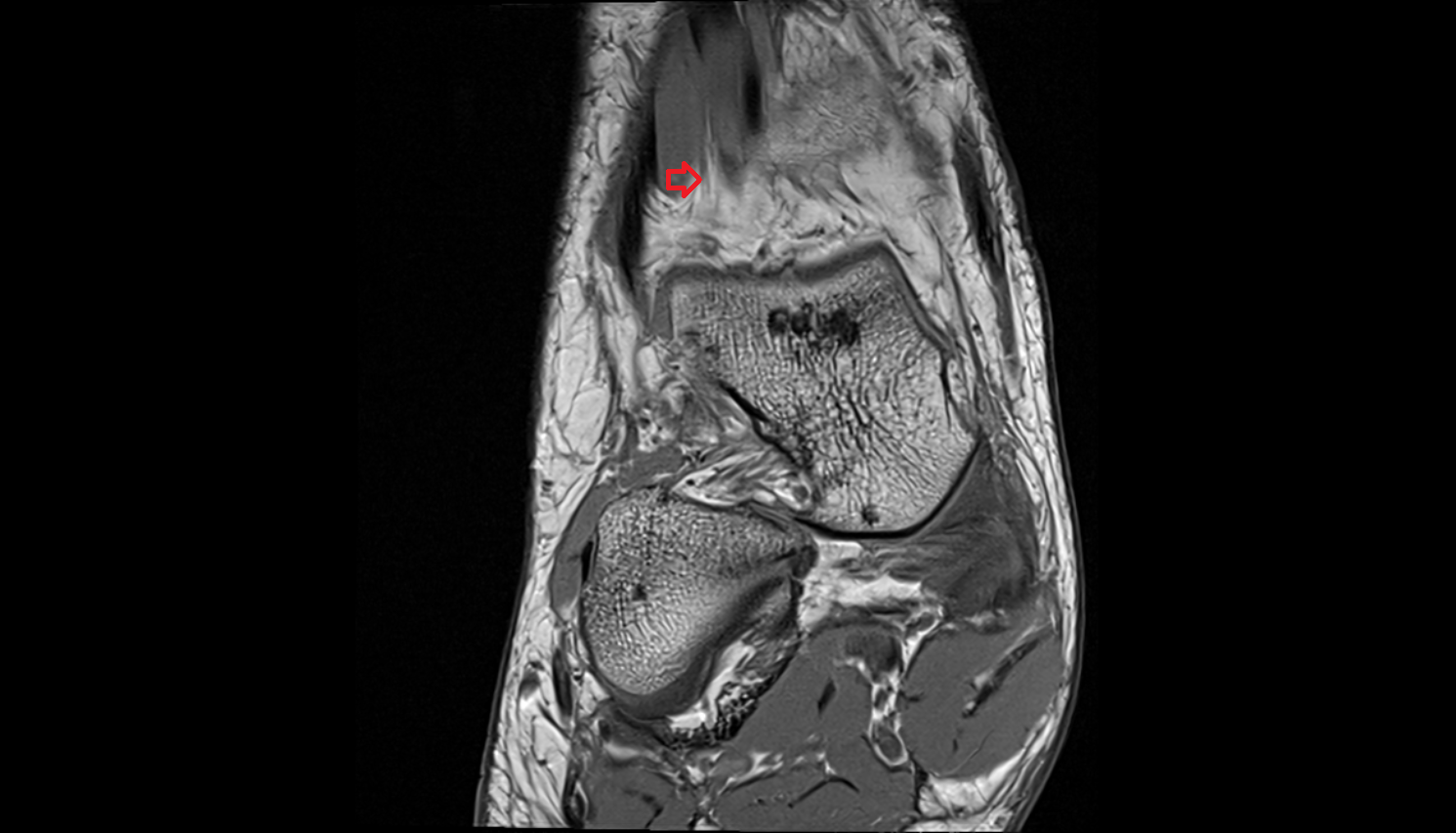 Deep fibular (peroneal) nerve coronal cross sectional anatomy 3T MRI AI enhanced radiology image-img-00000-00000