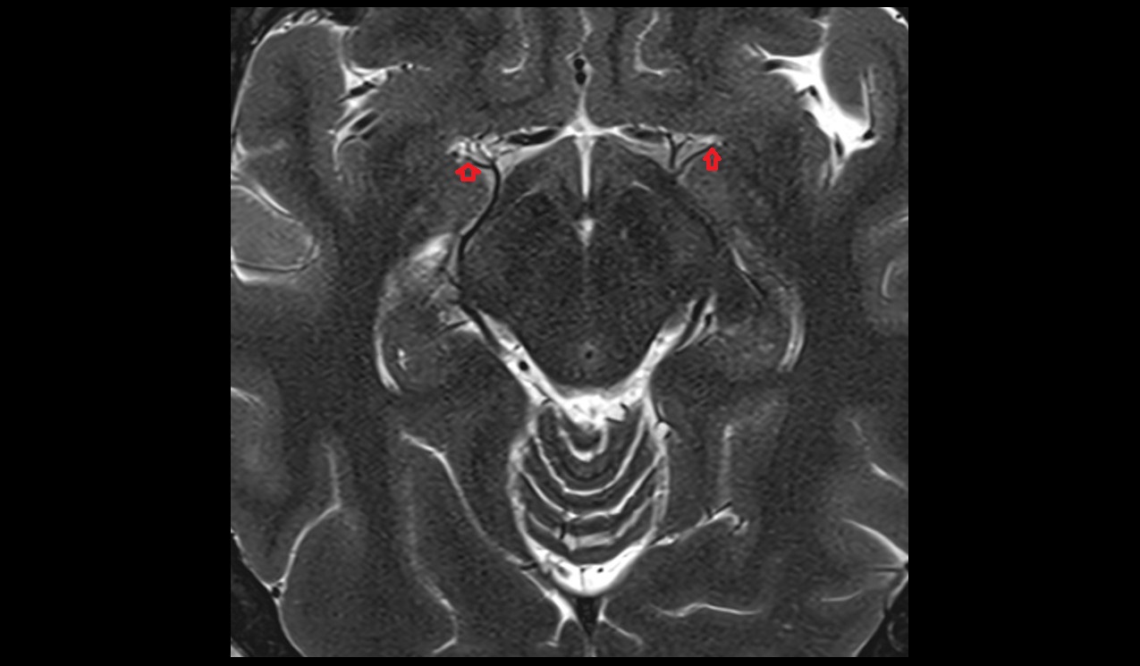 Deep mddle cerebral veins axial 3t mri image