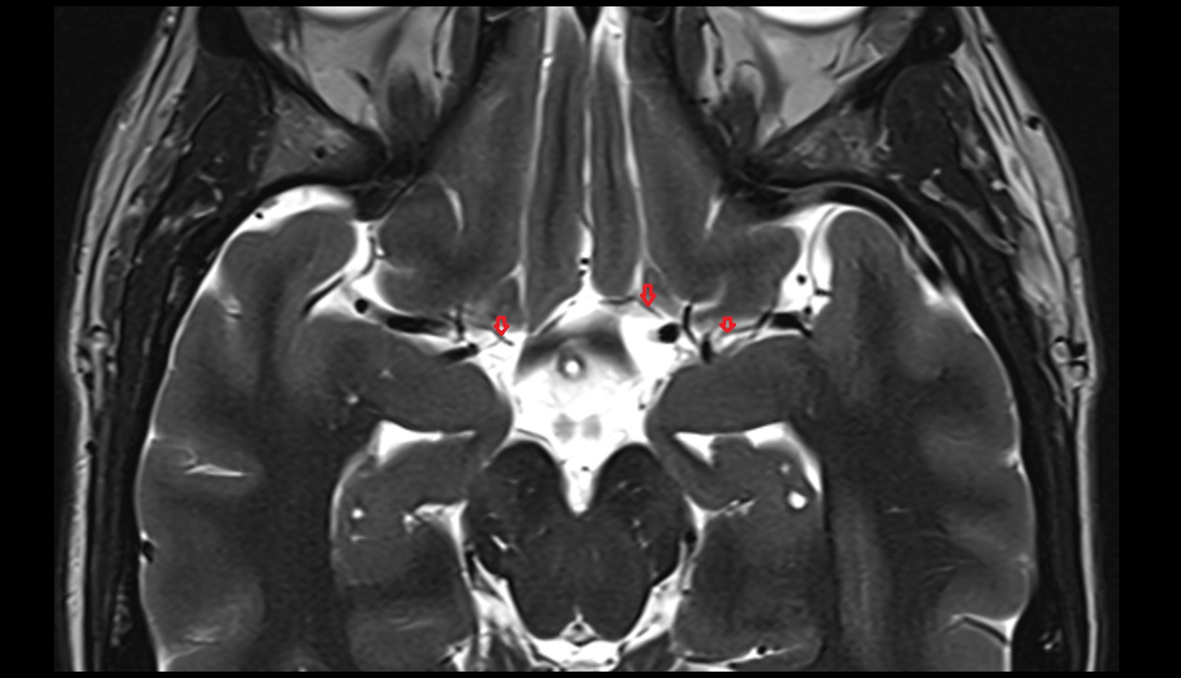 Deep middle cerebral vein